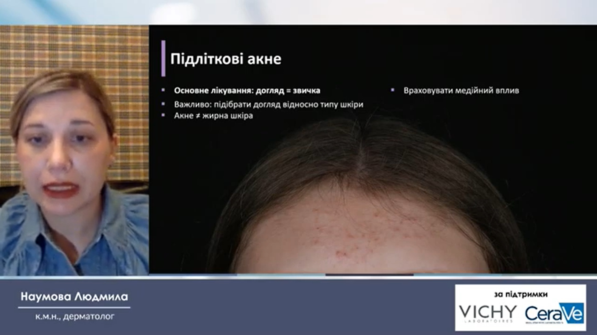 Лікування акне: догляд за шкірою