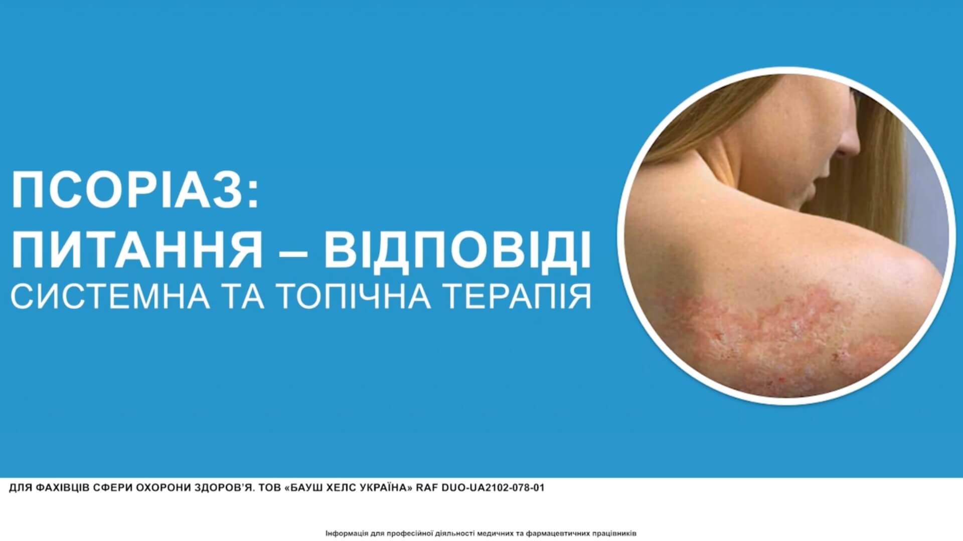 Псоріаз: системна та топічна терапія